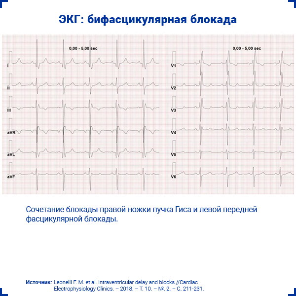 ЭКГ бифасцикулярная блокада